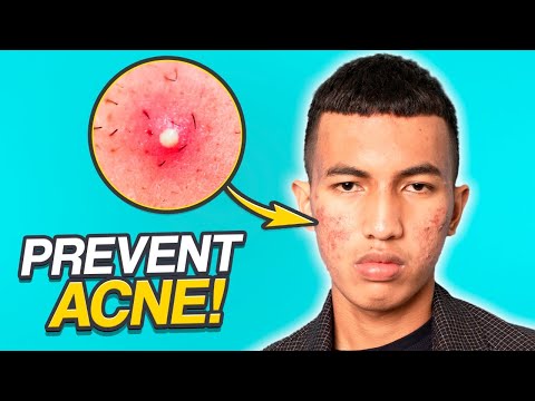 5 Easy Steps to Prevent Pimples Men's Easy Skincare