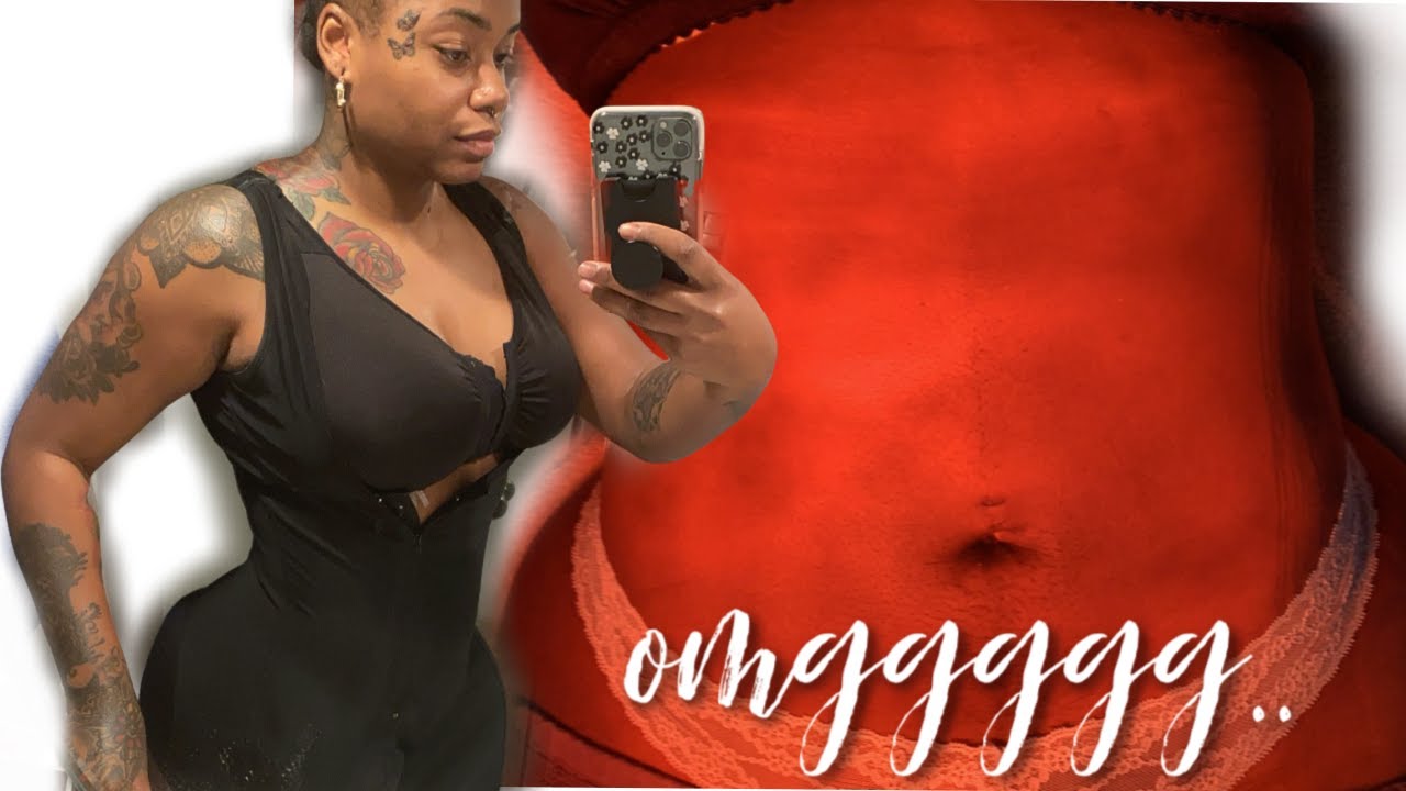 MY STITCHES CAME APART ๐ฉ๐ฉ๐ฉ + Post op massages | Surgery Vlog 2 - YouTube