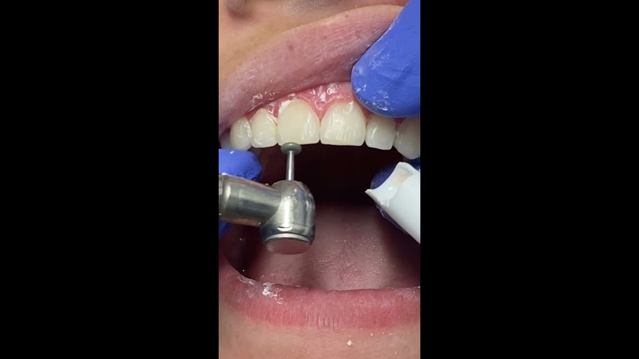 TAKING BRACES OFF Reels Braces Bracesoff Orthodontist Shullmanorthodontics