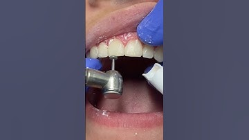 TAKING BRACES OFF🎉🎊 #reels #braces #bracesoff #orthodontist #shullmanorthodontics