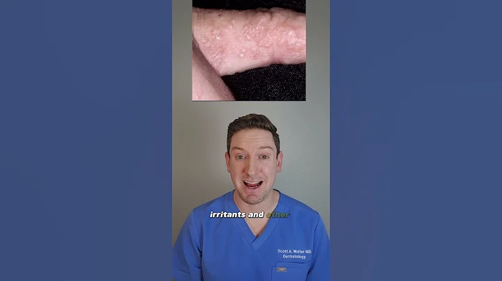 Derm's #1 tip for itchy finger bumps: Dyshidrotic Eczema #derm #fingerbumps #whatsonmyskin