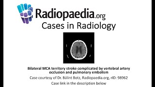 Bilateral MCA stroke, vertebral artery occlusion and PE (Radiopaedia.org) Cases in Radiology