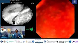 ERCP for Acute Cholangitis