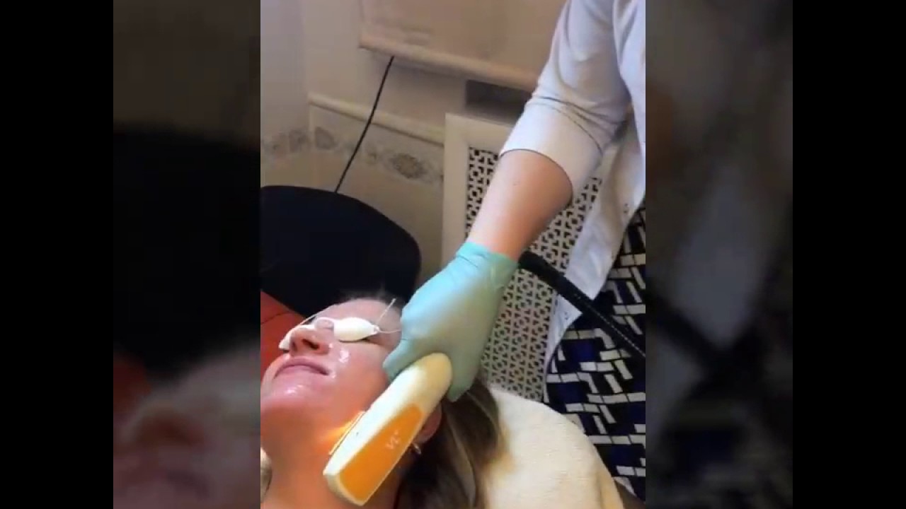 Электрокоагуляция на лице. Иссечение родинки лазером. Удаление тату лазером саранск. Выжигание родинки лазером. Перманентный макияж лазером.