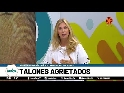 Talones agrietados Dra Sabina Hairabedián