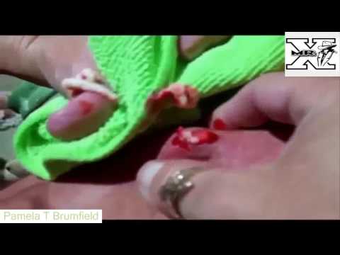 Top cystic acne, blackheads, acne horror squeeze in  - Pamela T Brumfield