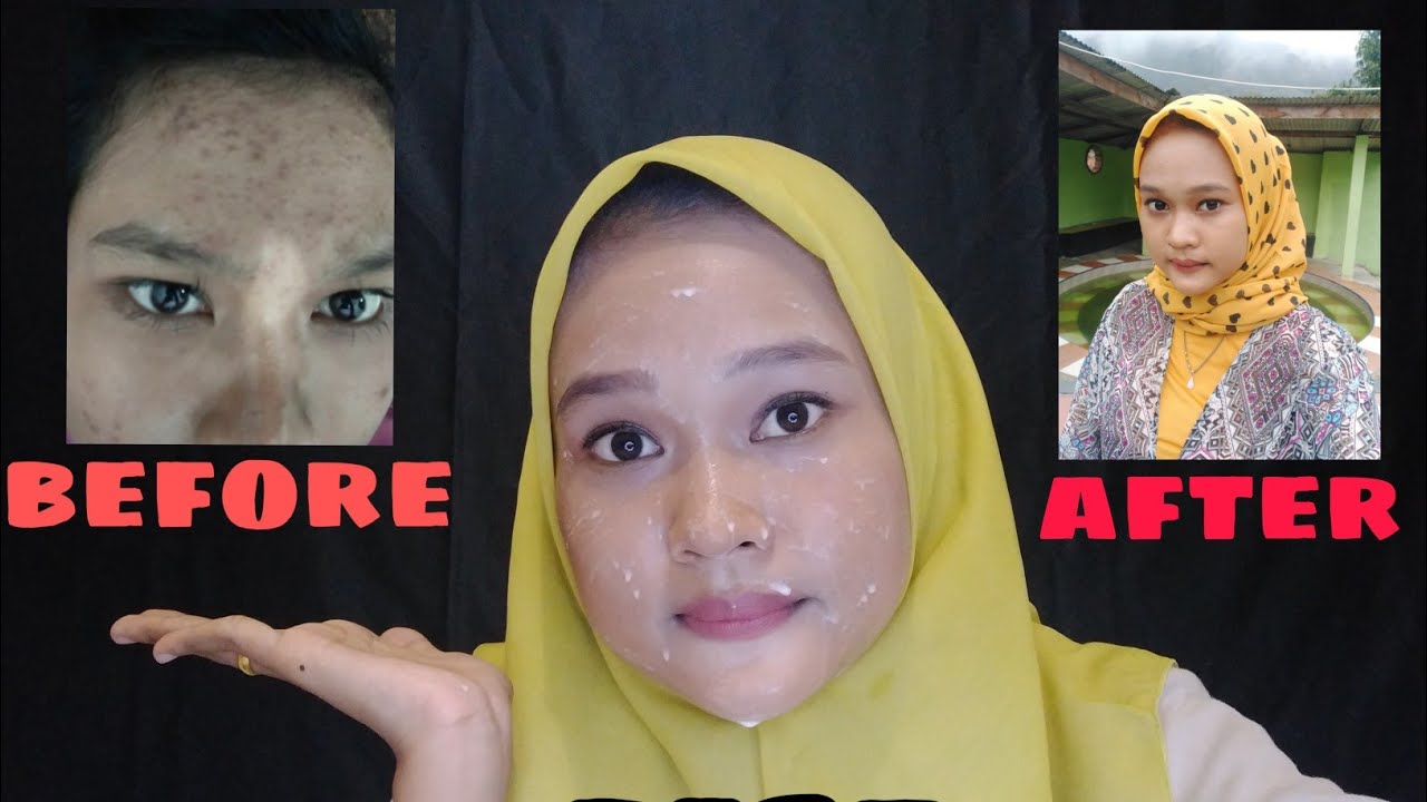Cara menghilangkan jerawat dengan mudah 