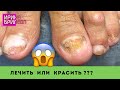 А можно мне покрыть ногти!?? 😱 Зачистка грибковых ногтей 😧 Педикюр 😯 Ирина Брилёва