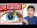 3 Must Know Facts About Visual Floaters!