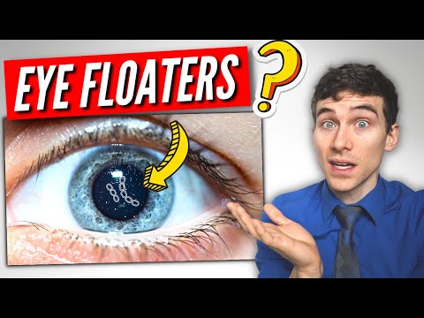 3 Must Know Facts About EYE Floaters!
