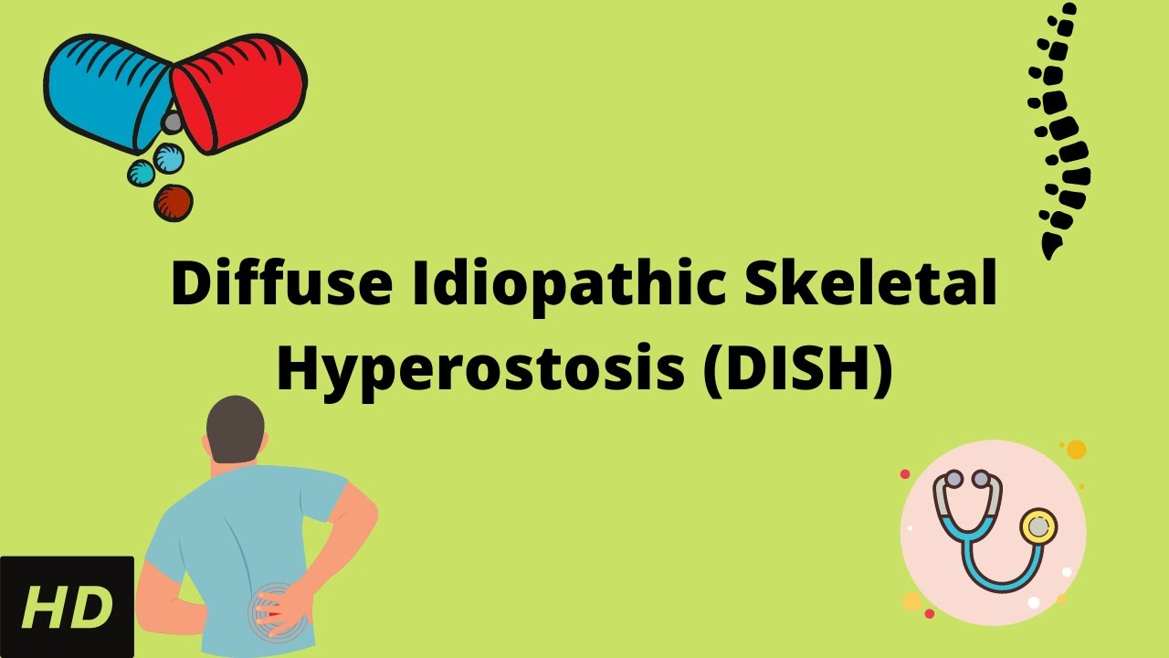 Diffuse Idiopathic Skeletal Hyperostosis DISH Causes Signs And diffuse-idiopathic-skeletal-hyperostosis-dish-causes-signs-and