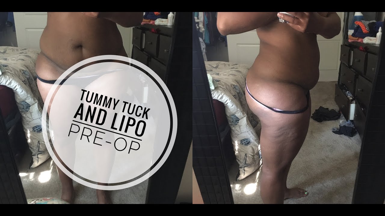 Tummy Tuck and Lipo Pre-Op with footage