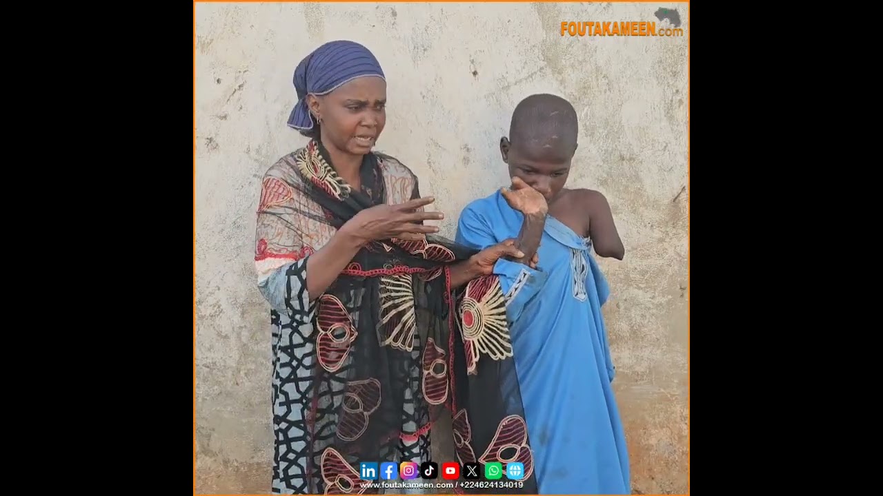 Le jeune Alpha Oumar, brûlé aux mains par son père à Mali pour un vol d’arachides il y 