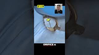 Canal Ledge Negotiation Solving Dental File Blockage
