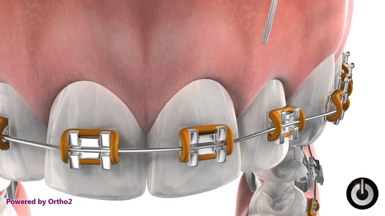 How to Floss Your Teeth During Treatment with Braces North York, ON