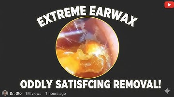 #55 Deep Ear Wax Removal ASMR 