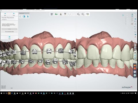 How To Use 3Shape Indirect Bonding Software with the BioQuick Bracket System