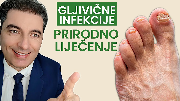 Gljivična infekcija noktiju? Evo kako je izliječiti bez lijekova