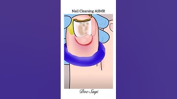 Nail Cleaning ASMR| Ingrown Toenail Treatment| #toenails #healtheducation #3danimation #shorts