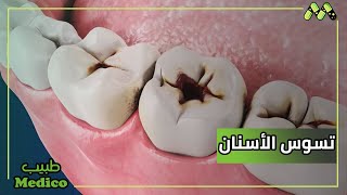 علاج تسوس الأسنان وأسبابه وكيفية الوقاية منه مع أ.د. نادر ميلاد