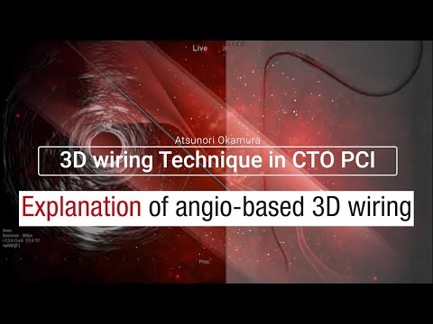 【Japanese】Explanation of angio-based 3D wiring