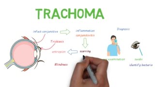 Trachoma - a devastating infectious eye disease