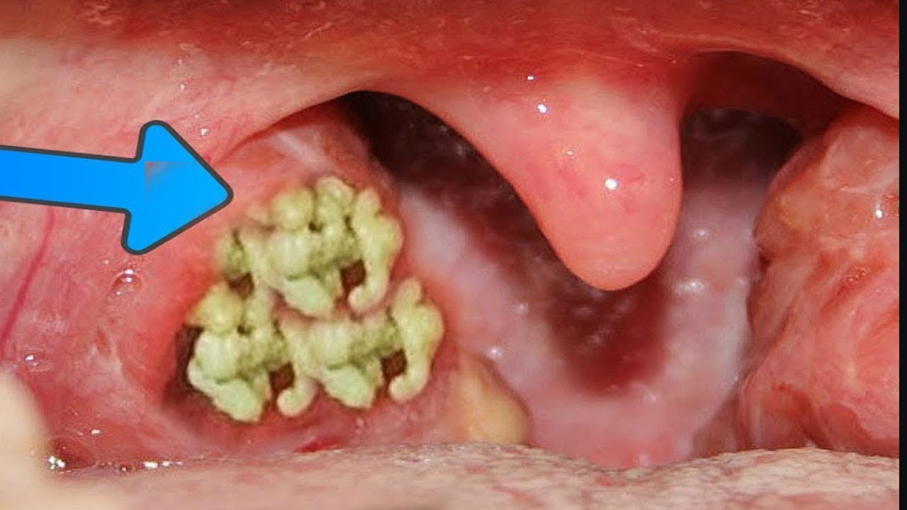 What Are Tonsil Stones What Causes Mucus Balls In Back Of Throat