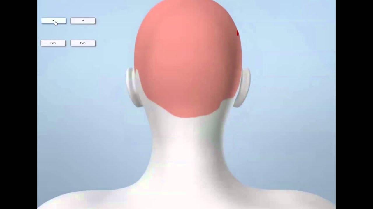 3D graphic of Leslie Neulander’s injuries YouTube