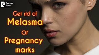 Can melasma or pregnancy marks be treated? - Dr. Amee Daxini