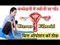           uterus fibroid treatment without surgery