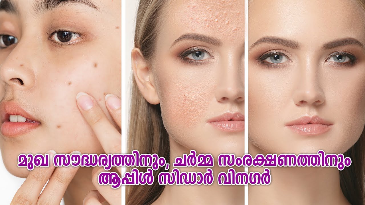 Apple cider vinegar for skin malayalam മുഖ സൗന്ദര്യത്തിന് ആപ്പിൾ സിഡാ