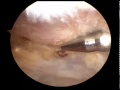 Arthroscopic subacromial decompression - Dr Terry Hammond.dv