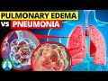 Pulmonary edema vs pneumonia