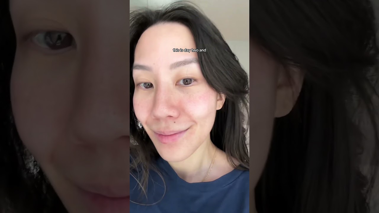 Very first moxi laser treatment!! 