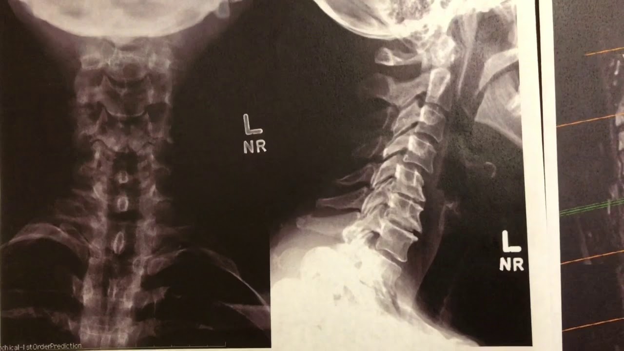 c4-7-minimally-invasive-acdf-in-active-and-healthy-radiology-technician