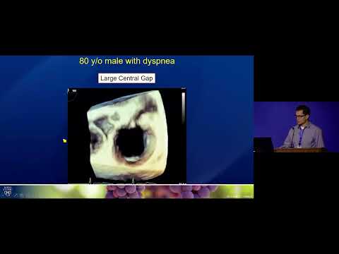 Tricuspid Valve Regurgitation