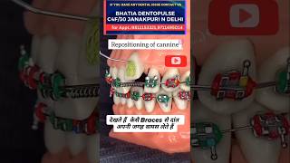 Dekhiye Braces Kaise Danton Ko Sahi Jagah Par Laate Hain