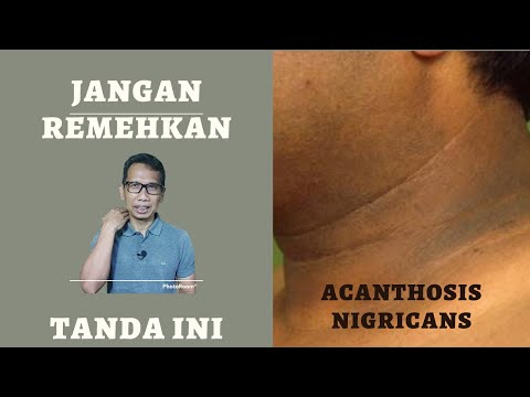 Jangan Remehkan Tanda Ini Bila Muncul di Tubuh Anda, Acanthosis Nigricans