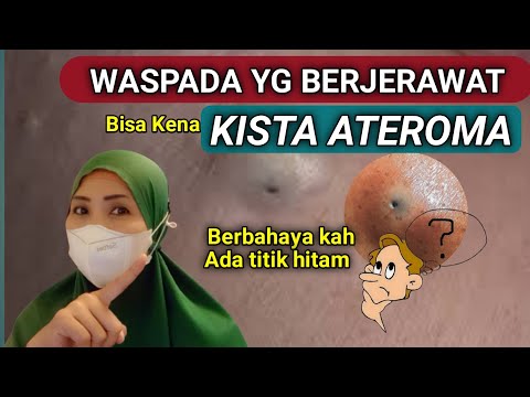 KISTA ATEROMA  ATAU KISTA SEBASEA - BENJOLAN DENGAN TITIK HITAM