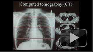 How Vivid Images are Reducing Lung Cancer Deaths