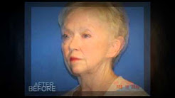 Facelift Ft Myers, Face Lift Fort Myers - Dr Audrey Farahmand