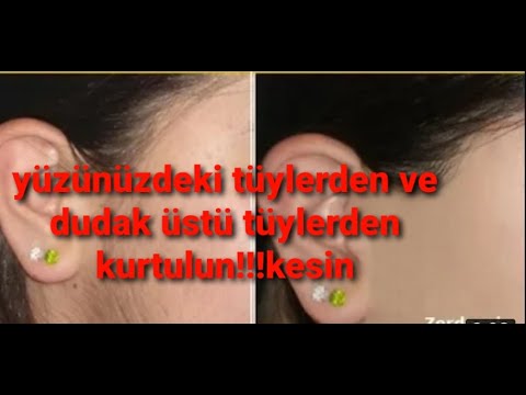 Yüzünüzdeki tüylerden💣 ve dudak üstü tüylerinden kurtulun zerdecal süt