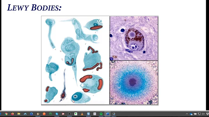 The progression of Parkinsons disease with Ruth Mu...