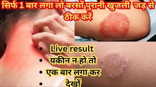 Remedy To Get Rid Of Ringworm, Scabies And Itching