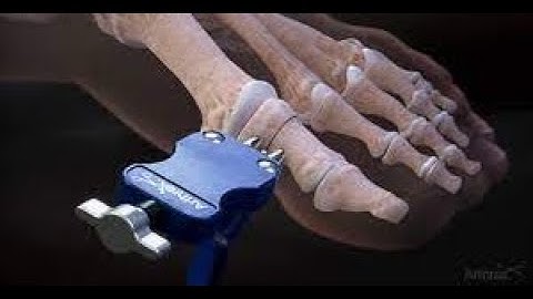 lapiplasty 3D & Akin Osteotomy 1st post-op appointment (10 days) @BAMagnet