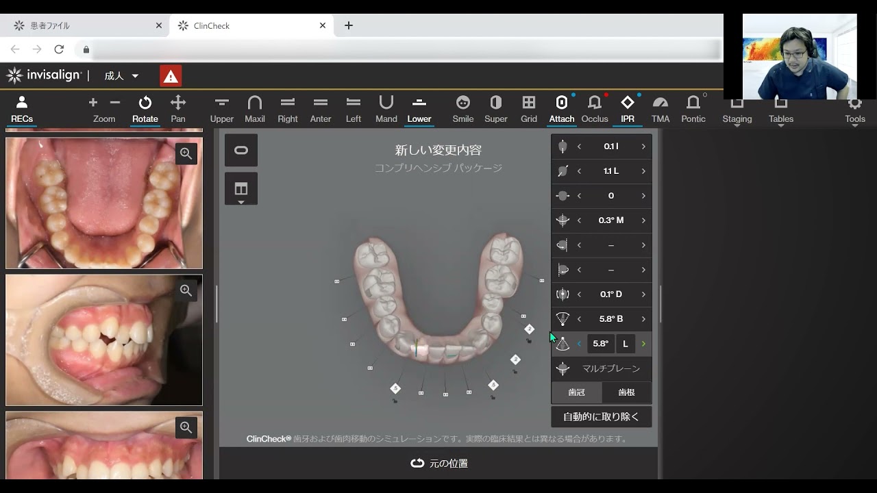 クリンチェック3Dコントロール修正の様子 - YouTube