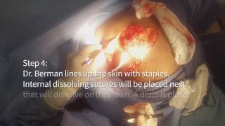 Gynecomastia - Male Breast Reduction After 100 Pound Weight Loss!