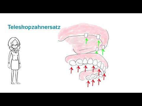 Video: Unterschied Zwischen Basalknochen Und Alveolarknochen