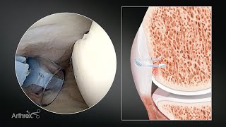 Live Surgery: Instability Repair With Remplissage Using Knotless FiberTak® Soft Anchors
Patrick J. Denard, MD (Medford, OR), performs a live surgery using Knotless FiberTak® soft anchors for instability. This design combines trusted knotless technology with the latest in suture innovation. The updates help improve implant insertion, help improve handling characteristics, and provide premium instrumentation with additional stability.
Learn more: https://arthrex.info/4nkveR6 Live Surgery: Instability Repair With Remplissage Using Knotless FiberTak® Soft Anchors