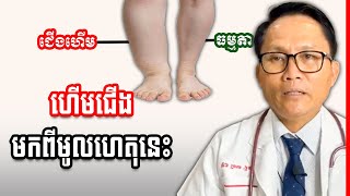 ហើមជើងមកពីមូលហេតុទាំងនេះ